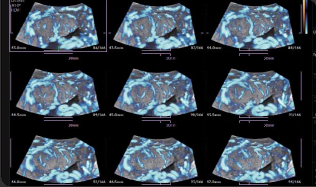 Placenta con MV-Flow™¹ 3D en modo MSV
