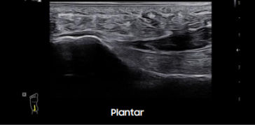 Plantar