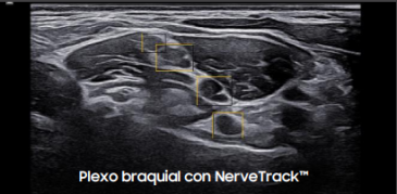 Plexo braquial con NerveTrack™