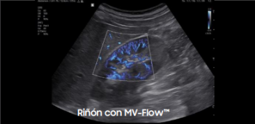 Riñón con MV-Flow™