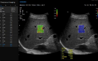 S-Shearwave Imaging
