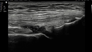 Tendón suprapatelar con HQ-Vision™