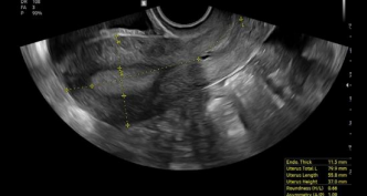 UterineAssist™