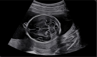 Vista TCV del cerebro fetal
