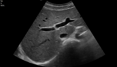 vista subcostal del higado